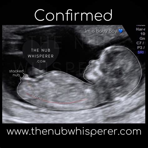 Baby gender nub theory | Nub theory, Gender prediction, Anatomy education