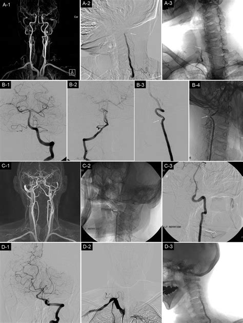 Vertebral Artery Occlusion