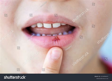 Pimple In Mouth Lip