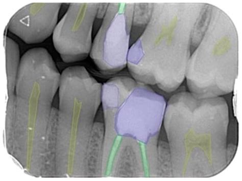 What Is Bitewing X Ray at Lyle Bowers blog - bitewing x ray