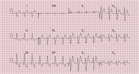 Image result for AFib Detection Algorithm