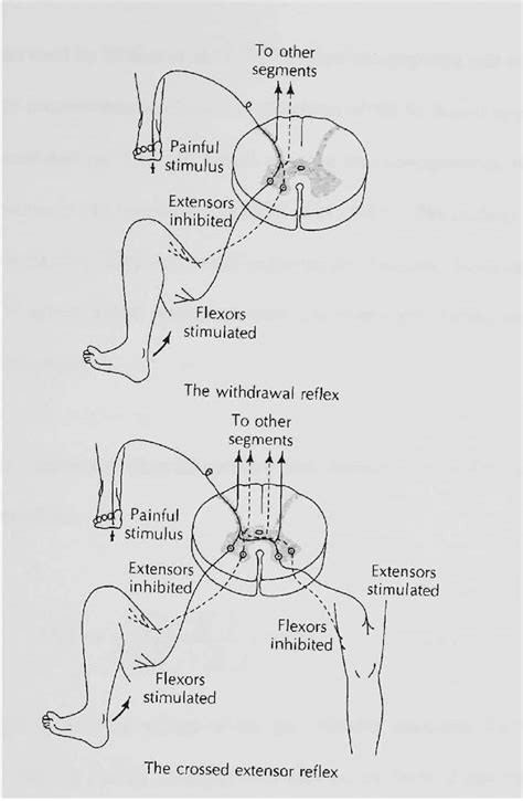 Image result for Crossed Extensor Reflex