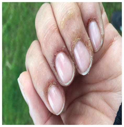 Contact dermatitis caused by methacrylates in nail products | CMAJ