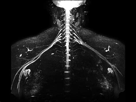 Non-invasive nerve plexus imaging | Philips MR Body Map