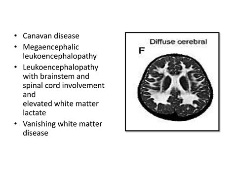 Approach to white matter disease | PPTX