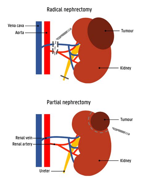 Image result for Nephrectomy Approach