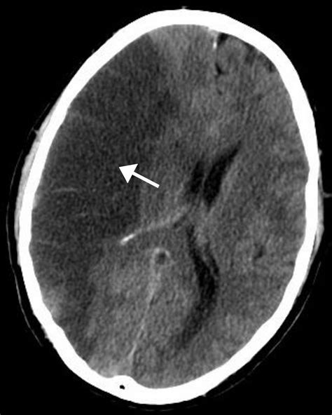 Stroke - WikiProjectMed