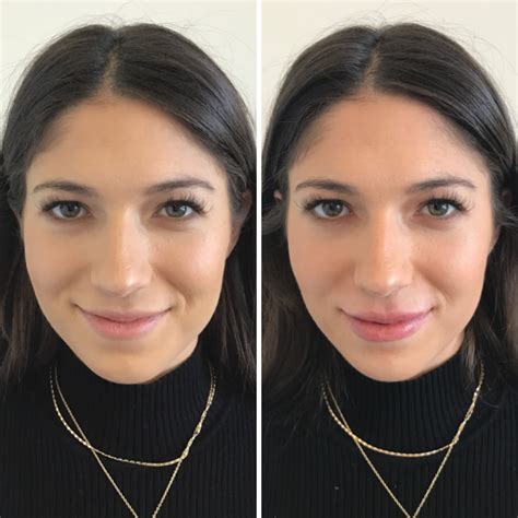 Subtle lip injections | Lip injections, Lip injections juvederm, Lips