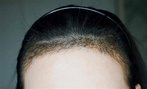倍生植发第13天了，种植的头发也有长长了一部分，发_圈子-新氧美容整形
