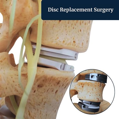Image result for Disc Replacement Procedure