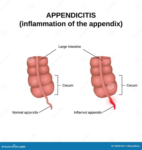 Image result for Appendix Inflammation