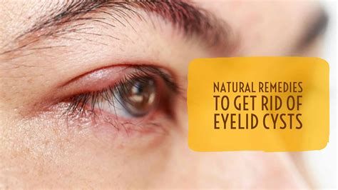 Eyelid Swelling Home Remedies at Andrew Mckeown blog