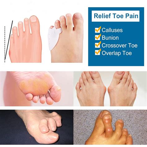 6Pcs Pinky Toe Protector, Pinky Toe Gel Bunion Protector, Soft Gel Toe Bunion Guards, Tailor ...