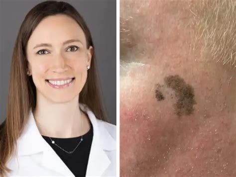 Skin cancer: Dermatologist approached a man on a train for the dark ...