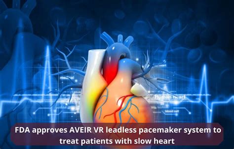 Journal Club - FDA approves AVEIR VR leadless pacemaker system to treat ...