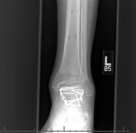 Timing of Definitive Fixation for Comminuted Talar Fractures in ...