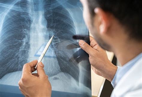 Corona clinging to lungs with silence, only CT scan will work