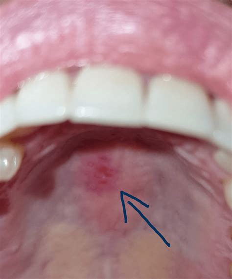 Does anybody know what this cluster of sores could be? They're on the ...