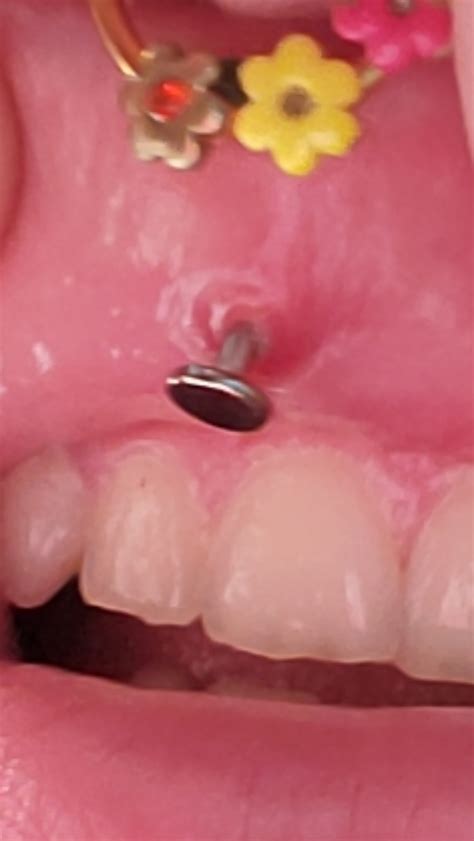 Bump inside medusa/swollen : r/piercing