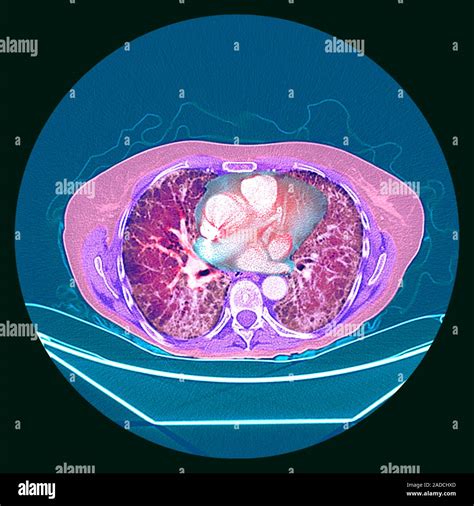 Pulmonary fibrosis. Coloured axial computed tomography (CT) scan of the chest of a 65-year-old ...