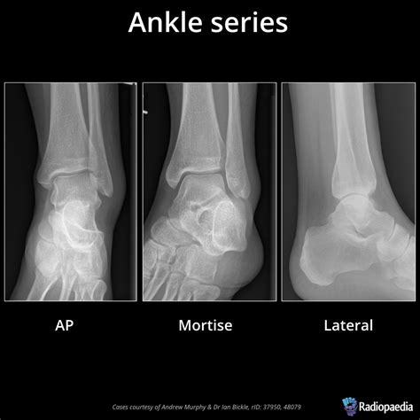 Normal Ankle Xray Ap