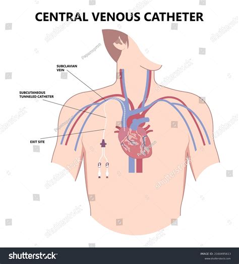 Central Venous Catheter Subclavian