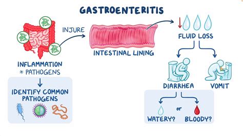 Infectious gastroenteritis: Clinical sciences - Osmosis Video Library