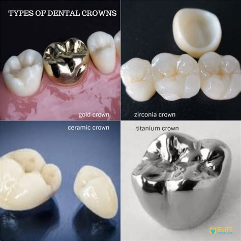 Comparing Types Of Dental Crowns – GRWZC