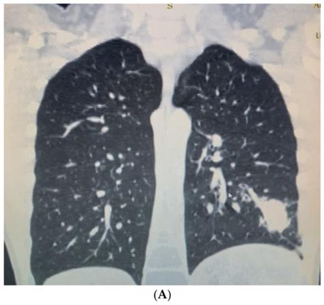 Surgical Treatment of Lung Abscess Due to an Awn Aspiration in a 9-Year ...