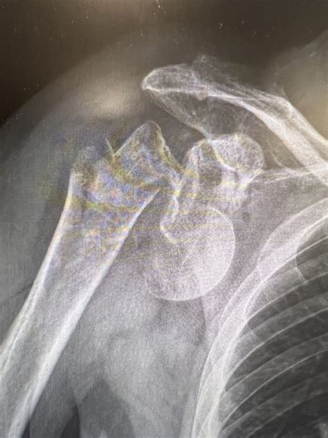 Humeral Neck Fracture – GANG