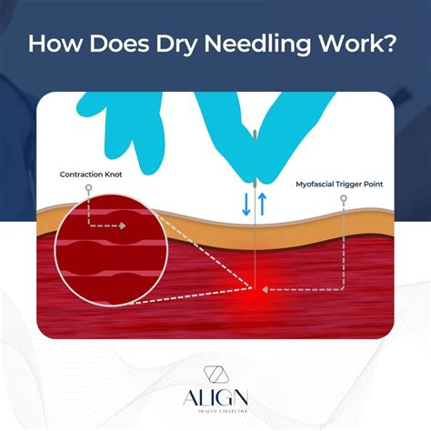 Dry Needling in Brisbane | Pain Relief & Recovery | AlignHC