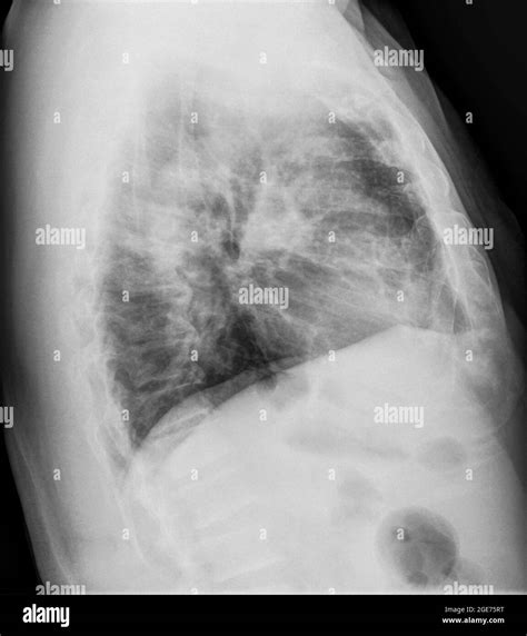 Normal Lateral Chest X Ray Male
