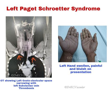 Krishna Chaitanya K H on LinkedIn: Left Paget Schroetter Syndrome