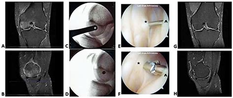 Spontaneous Bone Marrow Edema: Perfusion Abnormalities and Treatment ...