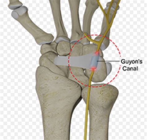 Ulnar (Guyonś) Canal