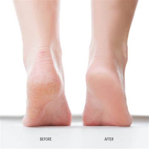 Are plantar warts contagious 6 things to know – Artofit