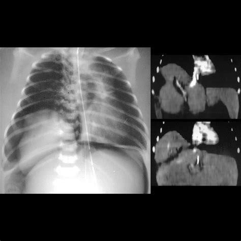 Newborn with respiratory distress and new abdominal distension | Pediatric Radiology Case ...