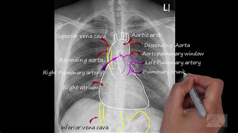 Image result for Chest X-Ray Tutorial