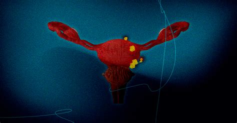 Bladder Cancer 的图像结果