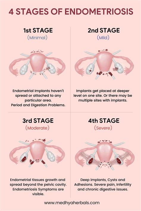 Endometriose Flare Up
