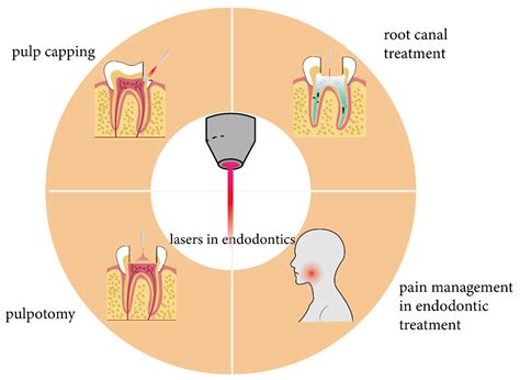 Current Applications and Future Directions of Lasers in Endodontics: A Narrative Review