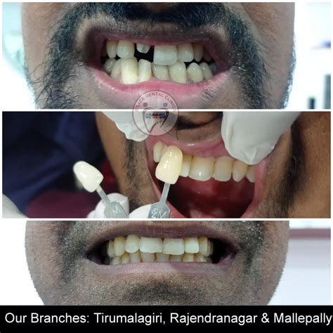 Crowns & Bridges - Brace Dental