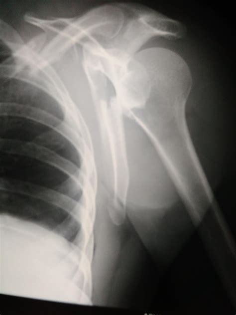 Scapula Fractures - Trauma - Orthobullets