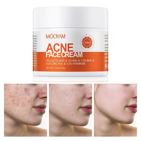 Amazon.com: Tratamiento para el acné para la cara, crema para el acné con ácido salicílico ...