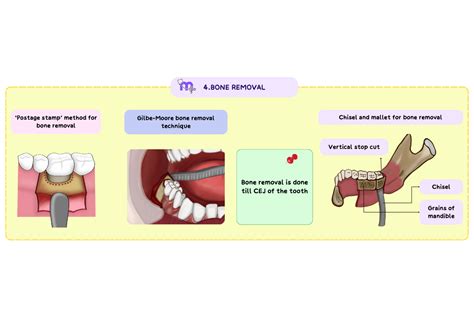 Management of Impacted Teeth: Surgical Approaches and Techniques – Medi ...