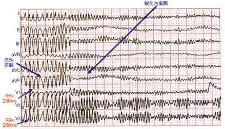 心电图图例分析：心房颤动伴长RR间期 - 爱爱医医学网