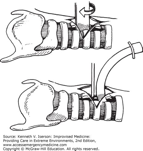 Anesthesia Airway Lavage 的图像结果