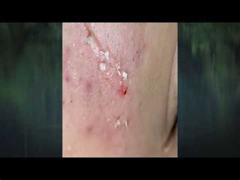 Exploding Cysts Compilation 的图像结果