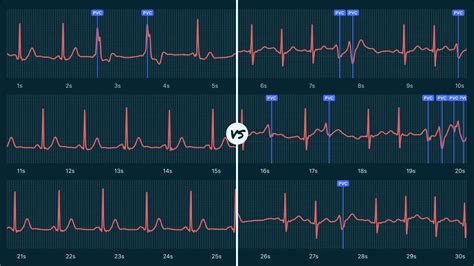 Premature Ventricular Contraction (Couplet) Vs. Ventricular Tachycardia ...