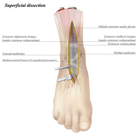 Image result for Ankle Anterolateral Approach Injection